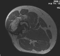 Chronic Ostetomyelitis Femur MRI Axial
